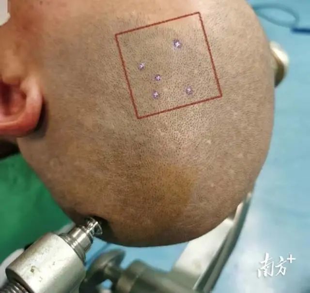 机器人描绘大脑地图精准导航切除脑肿瘤