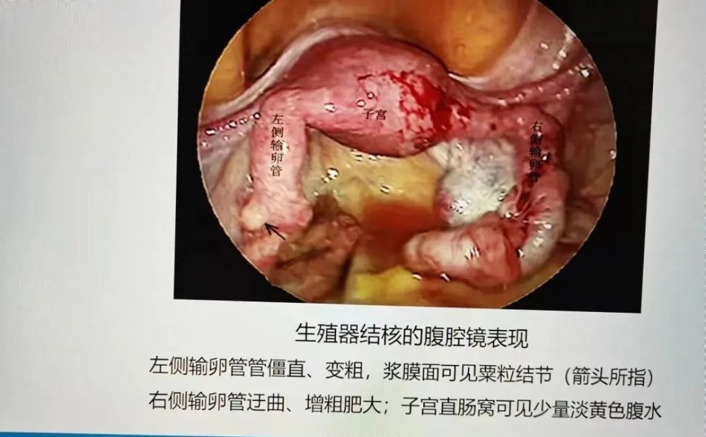 得力!盆腔结核"一言不发"-第1张图片-美宝网