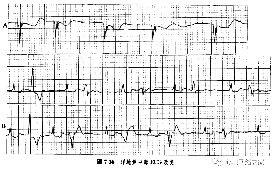 洋地黄中毒心电图2例