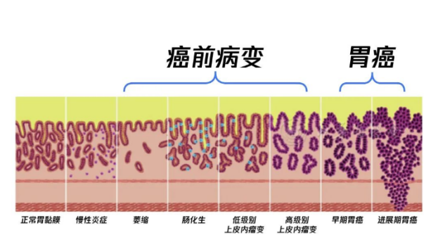 十胃九病,吃nc蘇芙衛三七白及膠囊,胃痛胃酸胃脹遠離你!