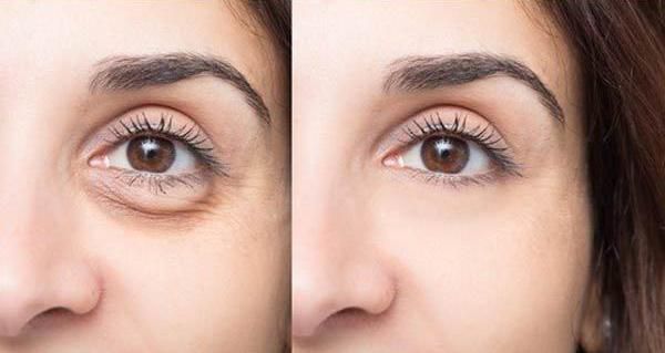 去眼袋的几种常见的误区有哪些?—眼袋熊师博士帮您解答_腾讯新闻