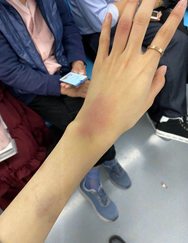 中爆料中可以看出来其确实是受了伤手臂上有一些淤青并带有检测报告