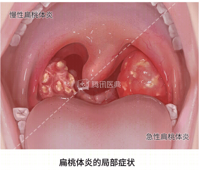 扁桃体长白色颗粒图片图片