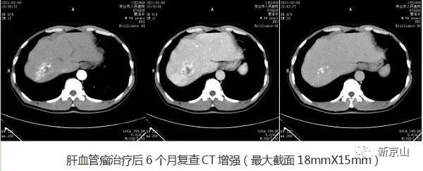 經ct增強檢查:肝血管瘤病灶大小為80mm×63mm.