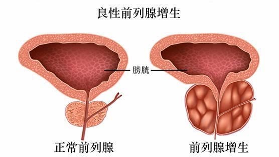 前列腺增生導致腎衰竭