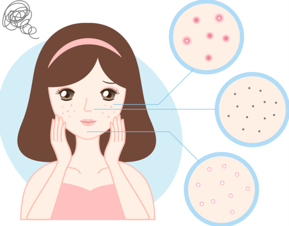 黑头,闭口反反复复?教你一招搞定!_腾讯新闻