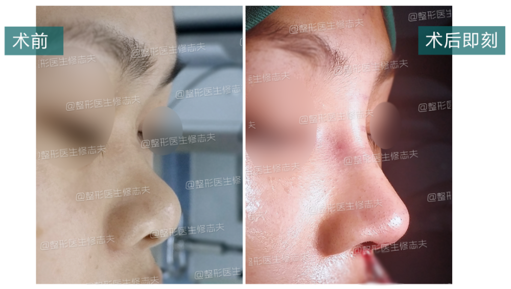 问题鼻型盘点 看看有没有你的同款 天天看点