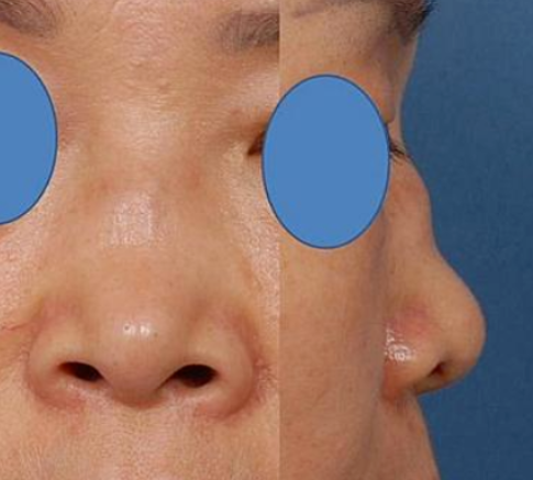 问题鼻型盘点 看看有没有你的同款 天天看点