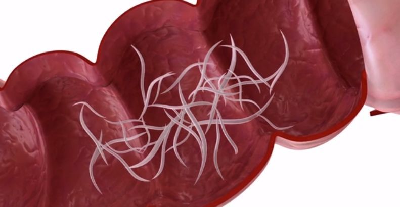 半夜在肛门产卵10000个这种刁虫专害孩子2招可治它