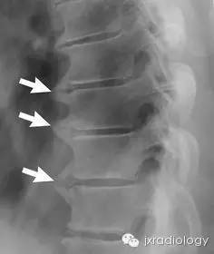 病變,包括受累區椎間盤高度存在,沒有真空現象;(3)缺乏上下關節突關節