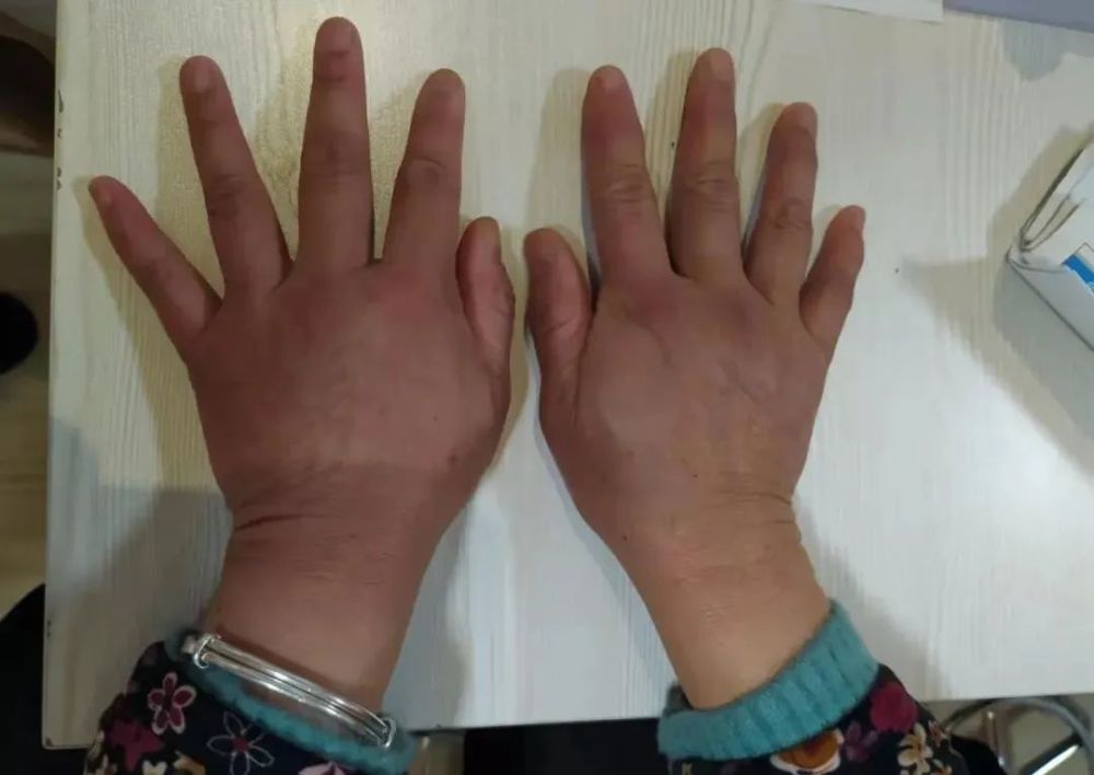 恭喜19522007年出生贵州人今起痛风风湿骨病患者这项补贴发放速看