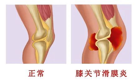膝盖详图_膝盖图示_膝盖各个部位疼痛图解分析