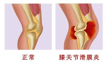 一文知道丨膝關節滑膜炎疼痛怎麼緩解?