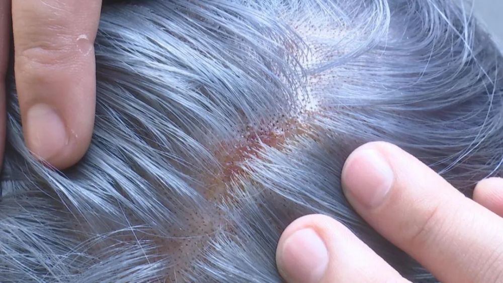 女子在韶关市区一发廊染发导致头皮受损起水泡咋回事