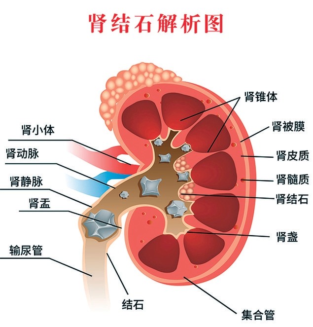 远离肾结石,多吃柠檬管用吗