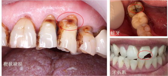 而牙本質就沒那麼堅硬了,它裡面有很多小管道,可使外層的刺激直接影響