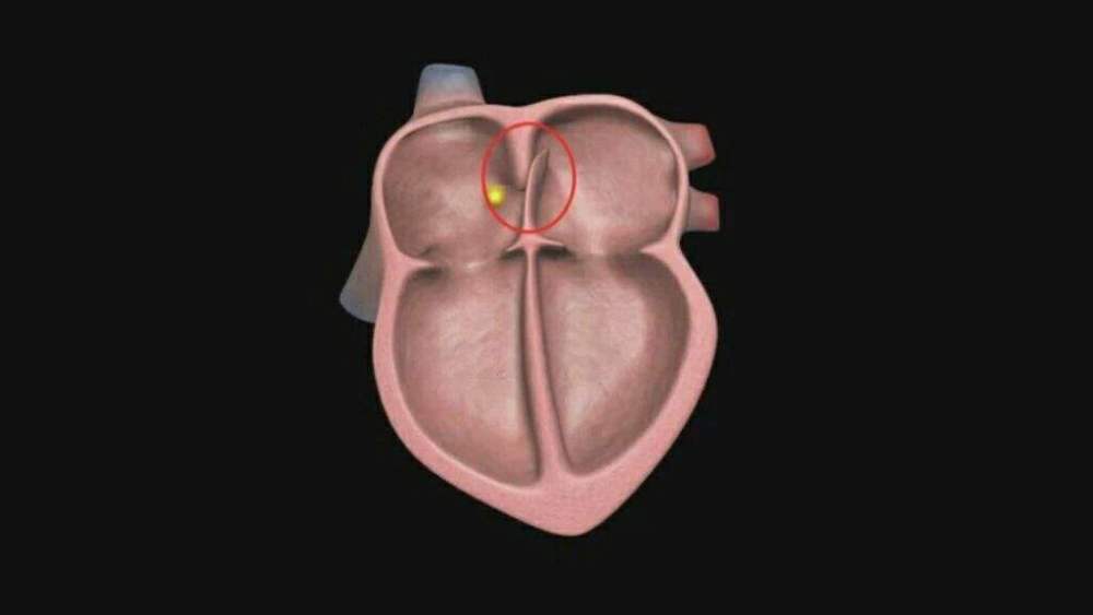 一高考生卵圆孔未闭导致脑血栓,医生提醒大家:这类人不能久坐_腾讯
