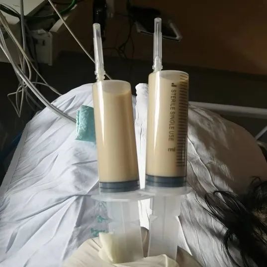 患者咳嗽胸闷气短乳白色胸腔积液意味着感染or恶性肿瘤形成乳糜胸的