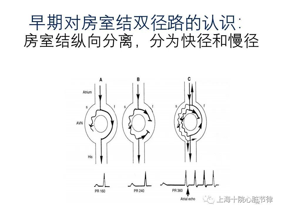 从病例中学习电生理房室结双径路的导管消融