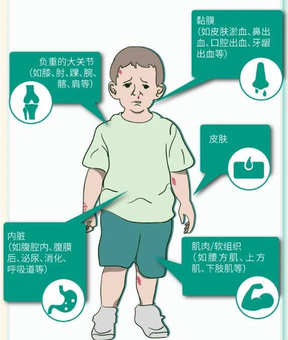 世界血友病日|血友病|血友病患者