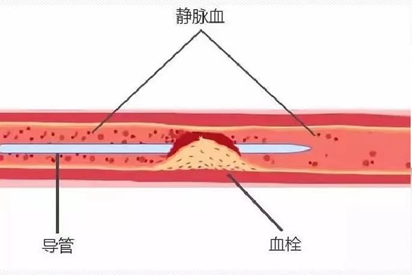 血管內常見置管有:中心靜脈置管cvc)和經外周穿刺中心靜脈導管(picc)