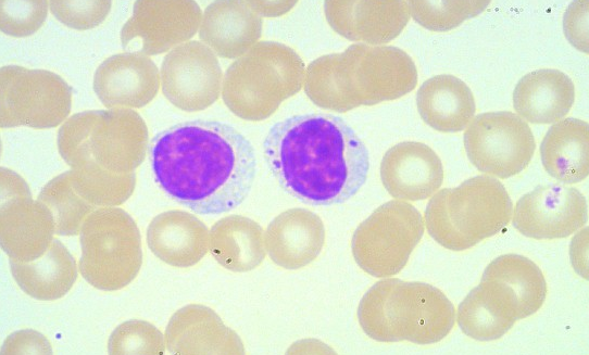 淋巴细胞增多背后的原因大颗粒淋巴细胞
