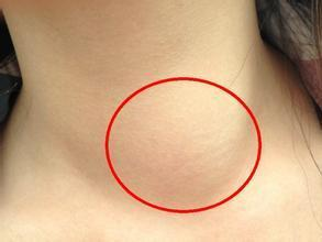 甲状腺结节有哪些早期正状!