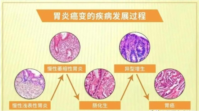 慢性萎縮性胃炎是怎麼回事該注意些什麼