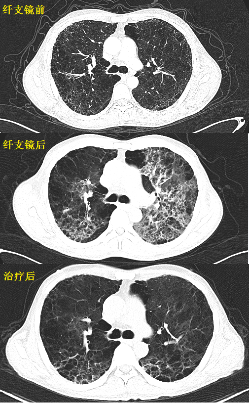 这份"肺纤维化 肺癌67"读片秘籍,请收好!