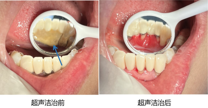 牙周治疗相当于外科手术,因牙龈炎症的存在,在治疗过程中会有出血现象
