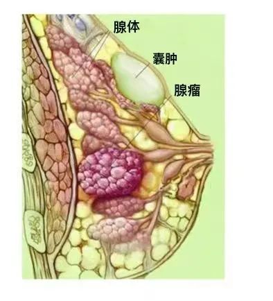女性发病率攀升到第一的乳腺癌应该如何及早发现和治疗