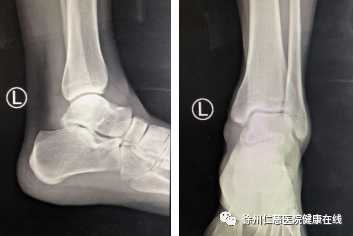 運動醫學男子高處摔落碰上少見距骨骨折仁慈關節鏡和機器人聯合手術