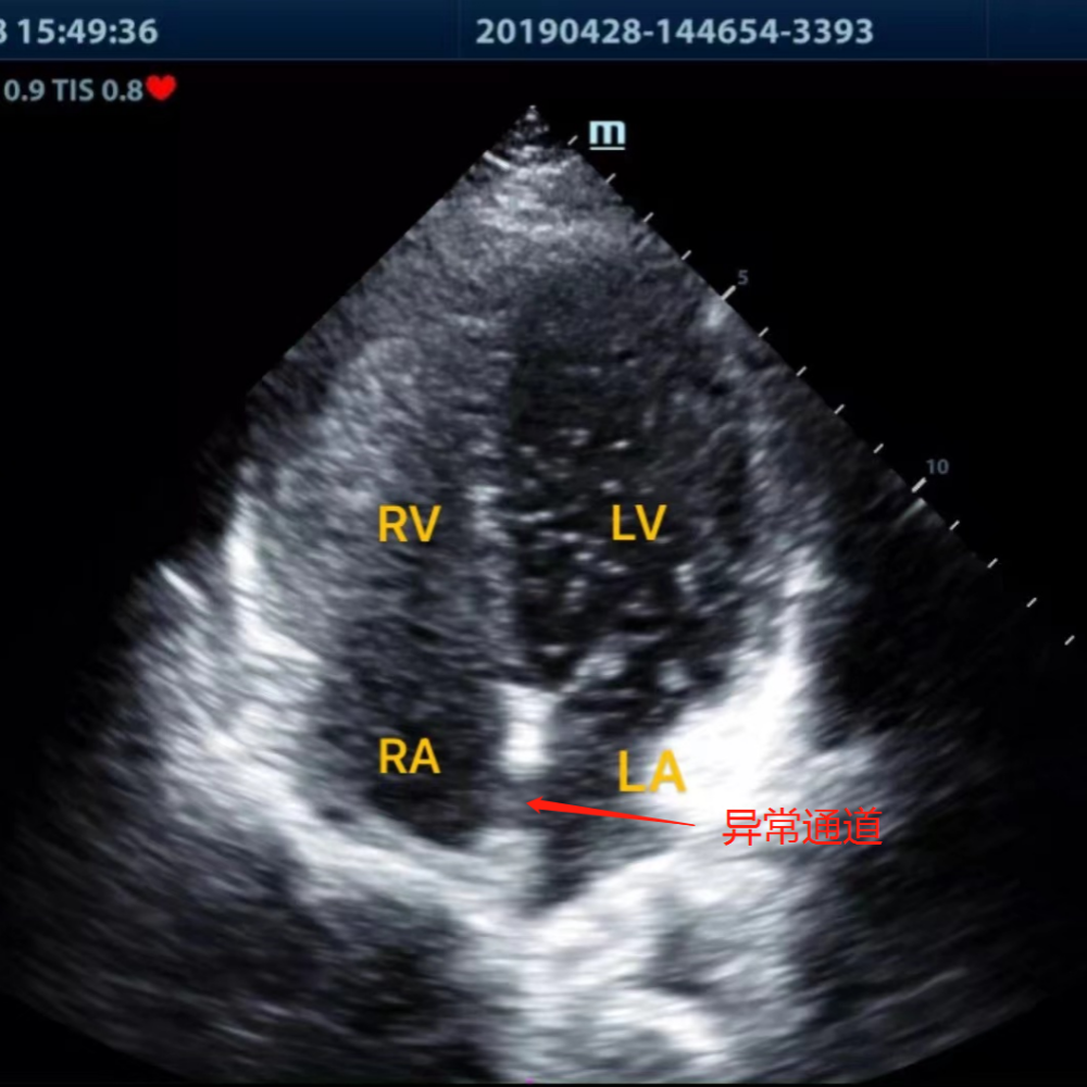 头痛查心找病因我院成功开展多例右心声学造影