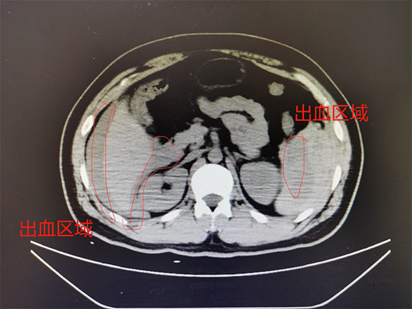 快递小哥连续工作12小时摔倒致脾脏破裂新华医院紧急手术