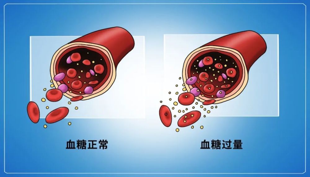 甜蜜杀手糖尿病并发症招招致命