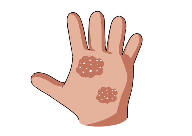 健康每一天|手脱皮是怎么回事?不一定是缺维生素