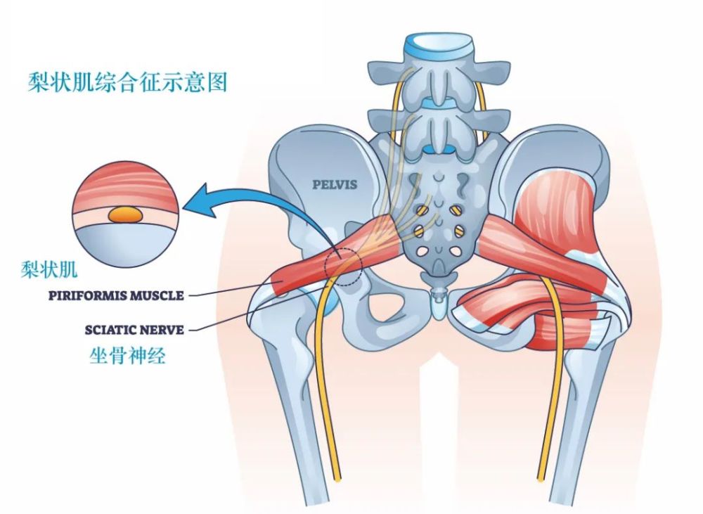 圖源:站酷海洛解剖sp:骶神經叢;s:坐骨神經;stl:骶結節韌帶;p:梨狀肌