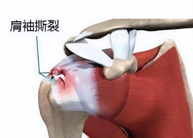 雌激素和睾酮缺乏可能增加肩袖撕裂的风险?一文看看这研究