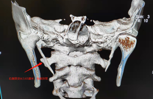 右脸胀痛10年被怀疑是精神问题 来到重庆仁品才知道是茎突综合征