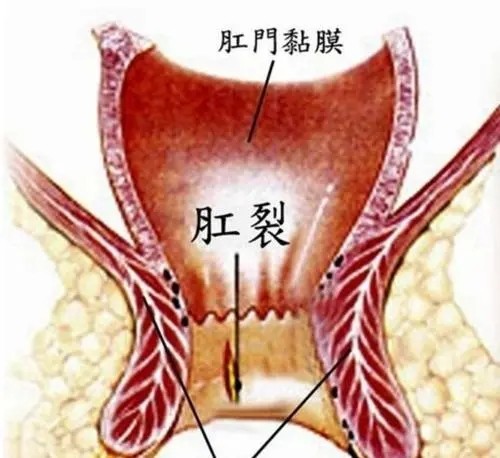 肛裂與肛瘻的