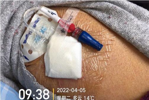 picc&port:肿瘤患者该如何选择输液工具?