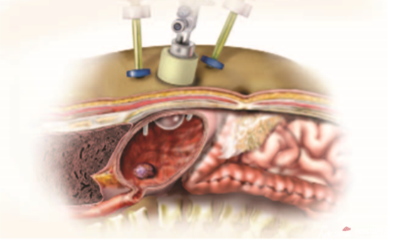用3d腹腔镜从患者胃中取出巨大瘤