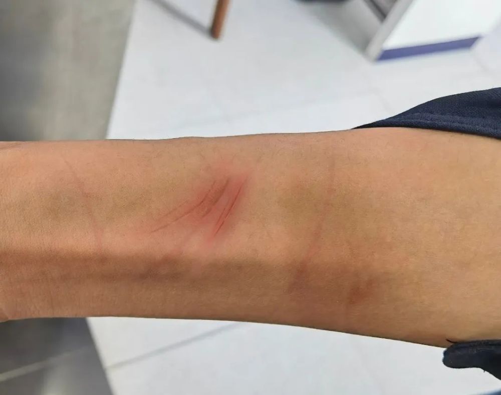 出警结束回到派出所后刘斌才发现自己的手臂被手铐勒出了深深的血痕