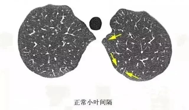 学习肺部 ct,一起来看看次级肺小叶有多少相关疾病与征象_腾讯新闻