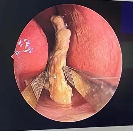 女子鼻腔内长结石罪魁祸首竟是多年前塞入鼻内的一粒串珠