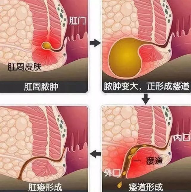 肛瘻一般是指肛門內到肛周皮膚的瘻管,通常由直腸肛管周圍膿腫潰爛或