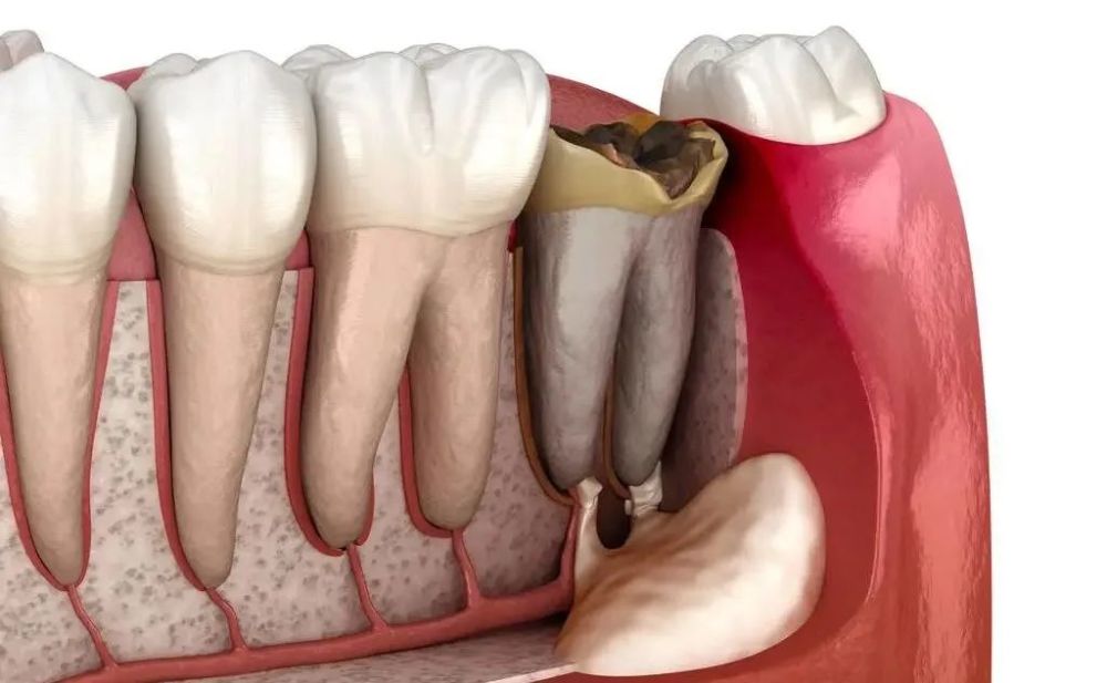 雖然發展到根尖周炎還有救,但如果依舊不及時治療,就會發展成根尖周
