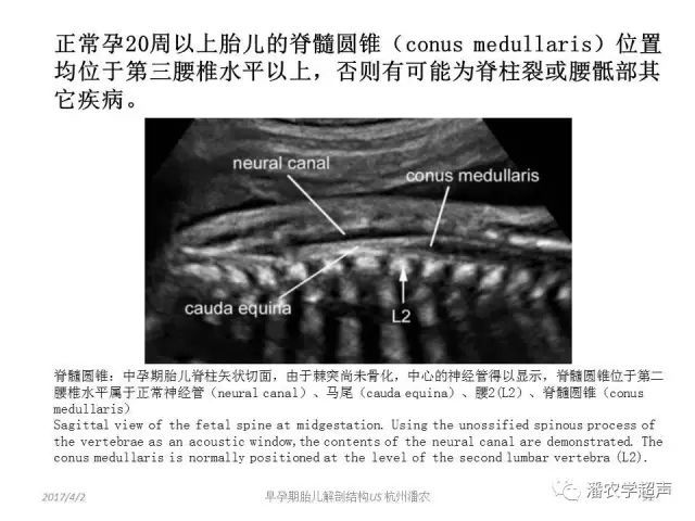 胎儿脊柱与脊髓圆锥