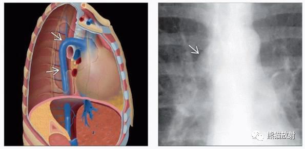 胸部影像診斷圖例體循環發育異常奇靜脈腔靜脈主動脈