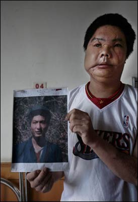 中国换脸第一人李国兴2006年背60斤西药回家两年后离奇去世